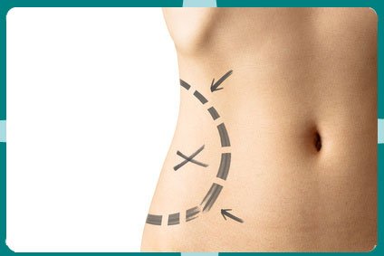 Tummy Tuck in Mexico Tummy Tuck in Mexico